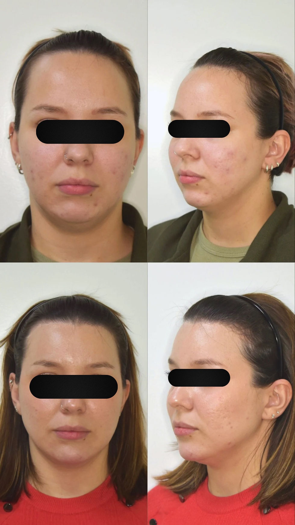 Dra. Patricia Marques e a Frontoplastia: Conheça a especialista em São Paulo