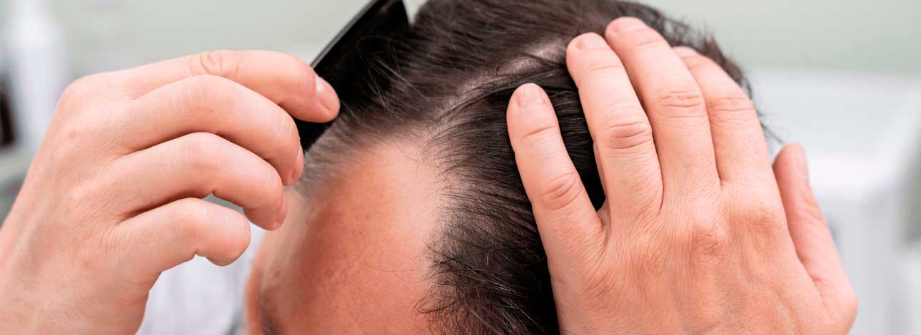 Tratamentos Regenerativos para Calvície: Exossomos