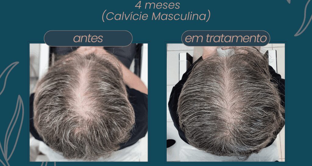 Técnica FUE: O que é e por que a Clínica Ruston é referência?