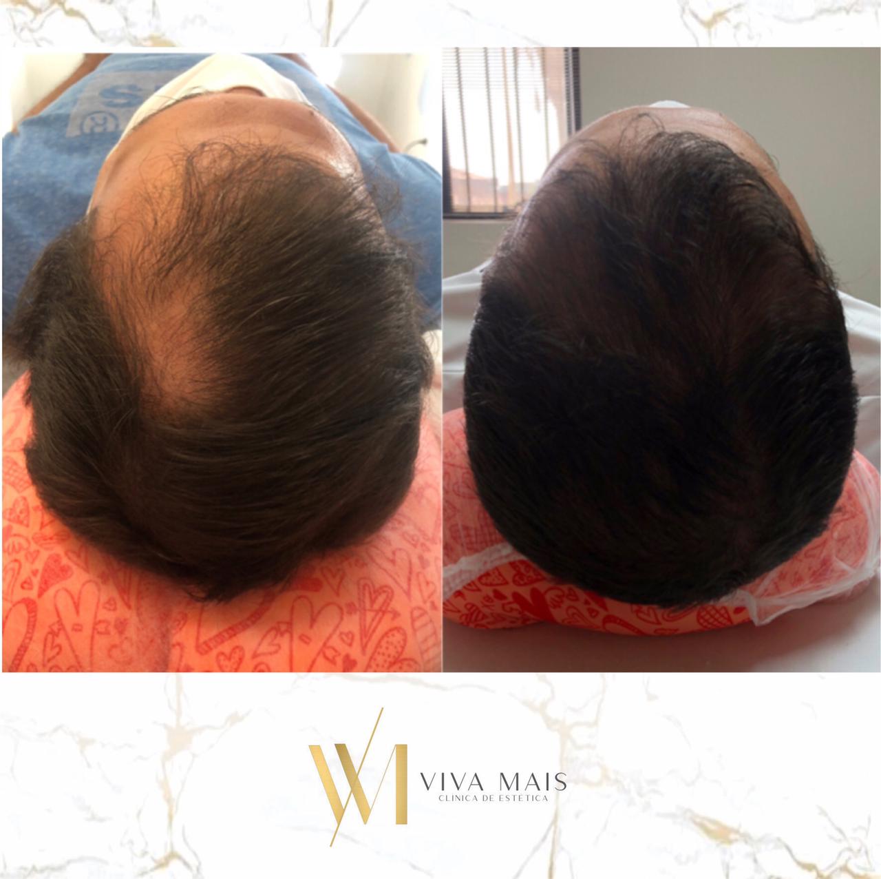 Técnica FUE: O que é e por que a Clínica Ruston é referência?