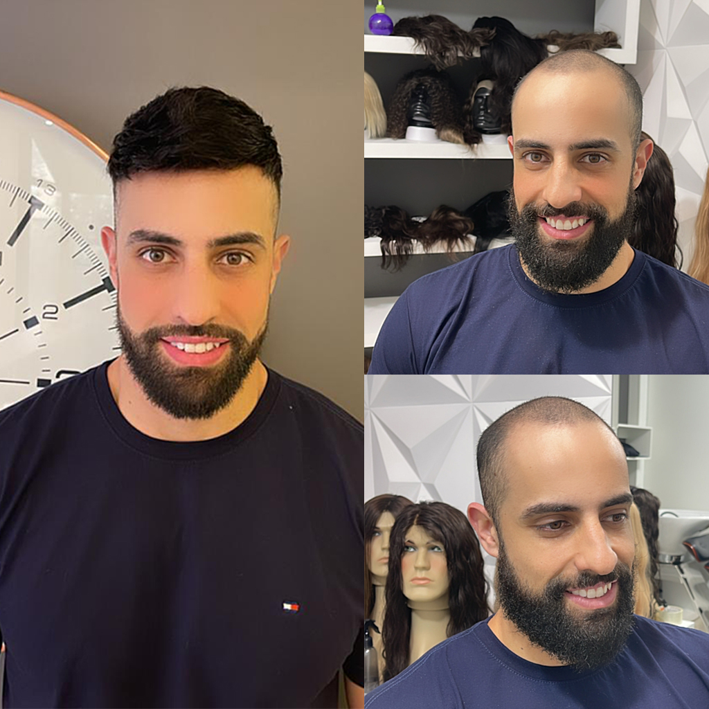 Prótese Capilar Não Cirúrgica: Vantagens e Desvantagens