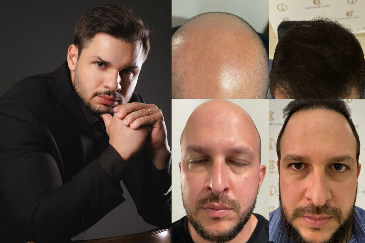 Clínica de transplante capilar de luxo SP