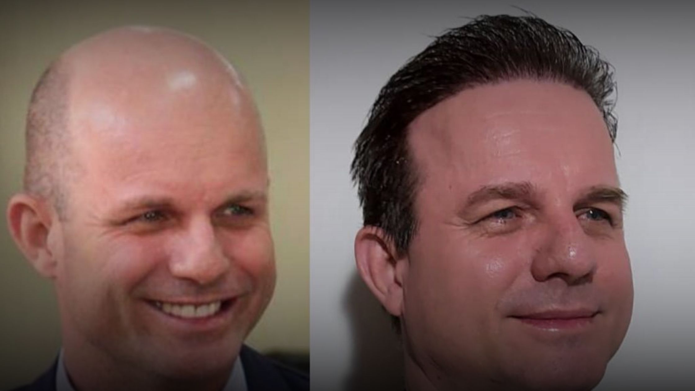 FUE vs FUT: Qual a Melhor Técnica de Transplante Capilar para Você?