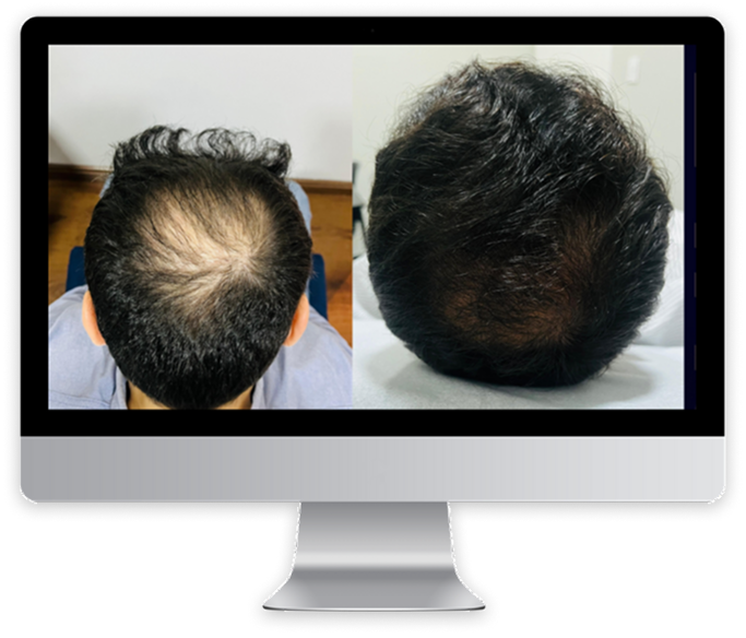 Tratamentos Não Cirúrgicos para Queda de Cabelo em Betim