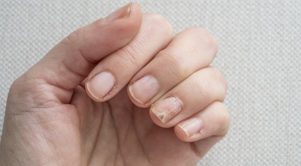 como acabar com fungos nas unhas rapidamente