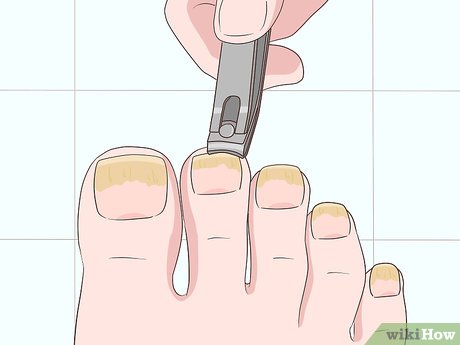 melhores tratamentos para fungos nas unhas rápido