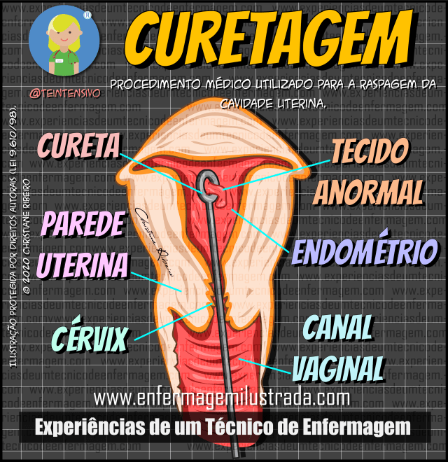passo a passo da curetagem uterina