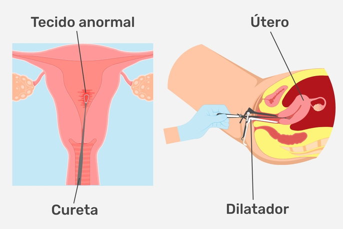 como é feito a curetagem