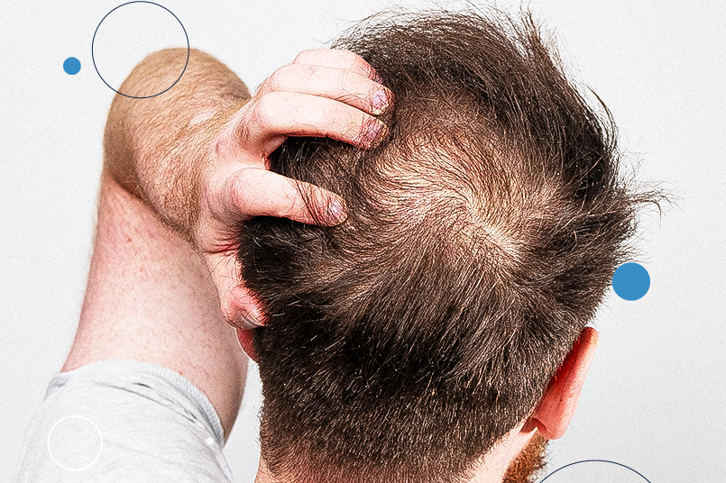 Remédios Caseiros e Cuidados Naturais para Combater a Queda de Cabelo: Babosa e Mais