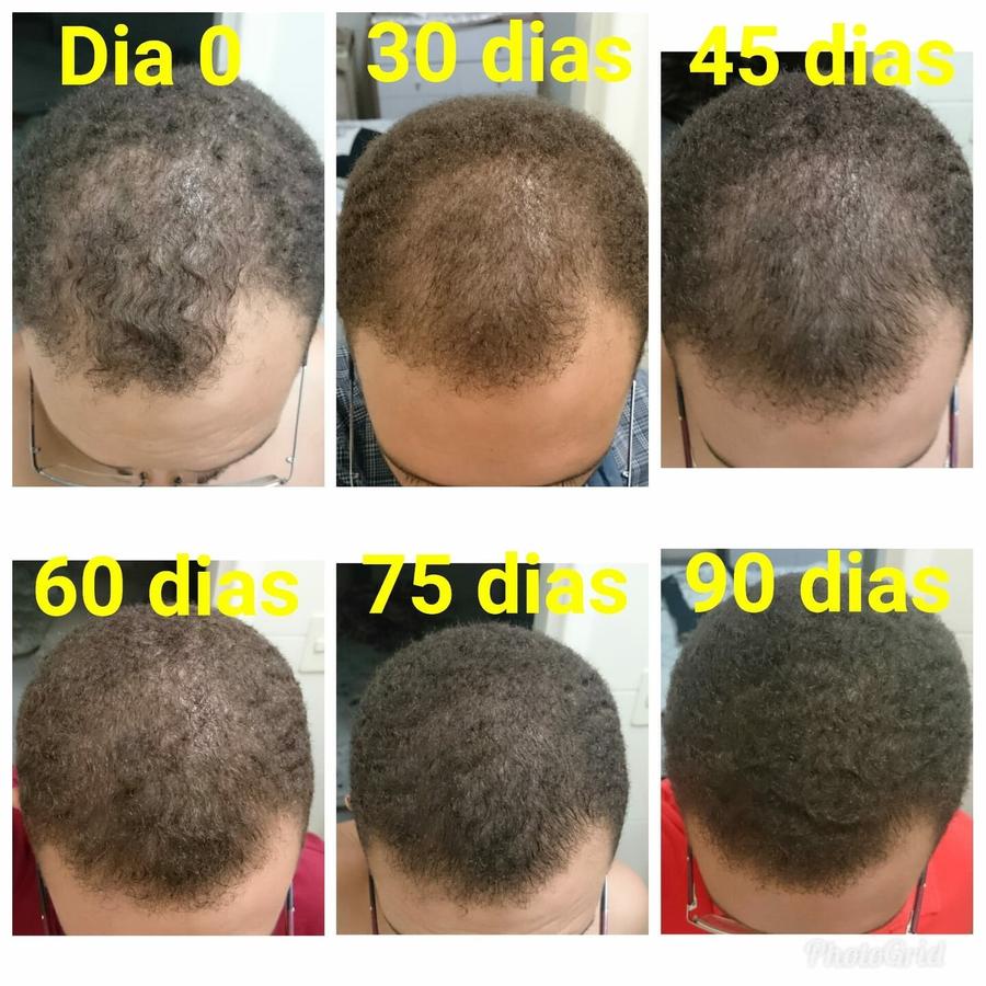 Como a Alimentação e Suplementação Correta Podem Parar a Queda de Cabelo