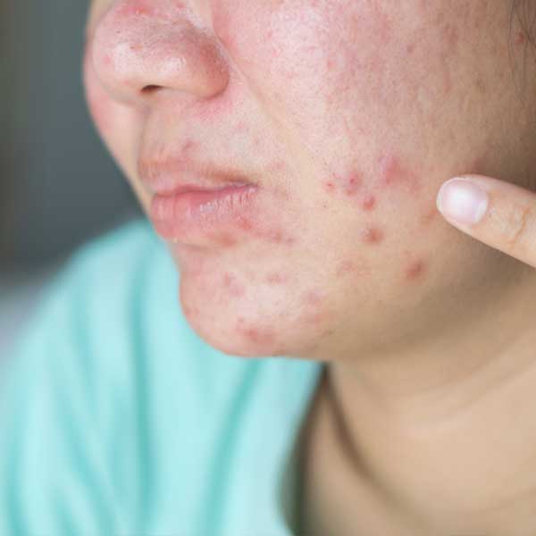 erros comuns ao tratar espinhas que pioram a acne