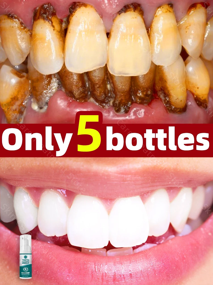 melhores formas de remover tártaro em casa