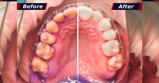 erros comuns ao tentar remover tártaro caseiro