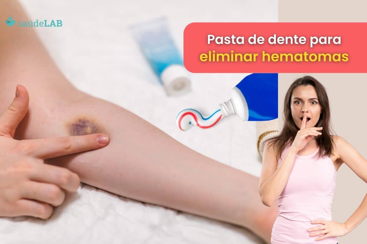 como eliminar hematomas