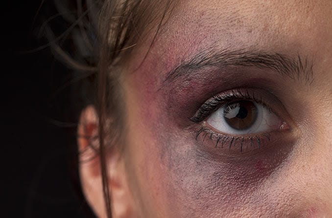 como eliminar hematomas