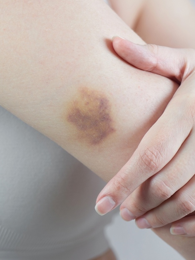 acelerar cicatrização de hematomas