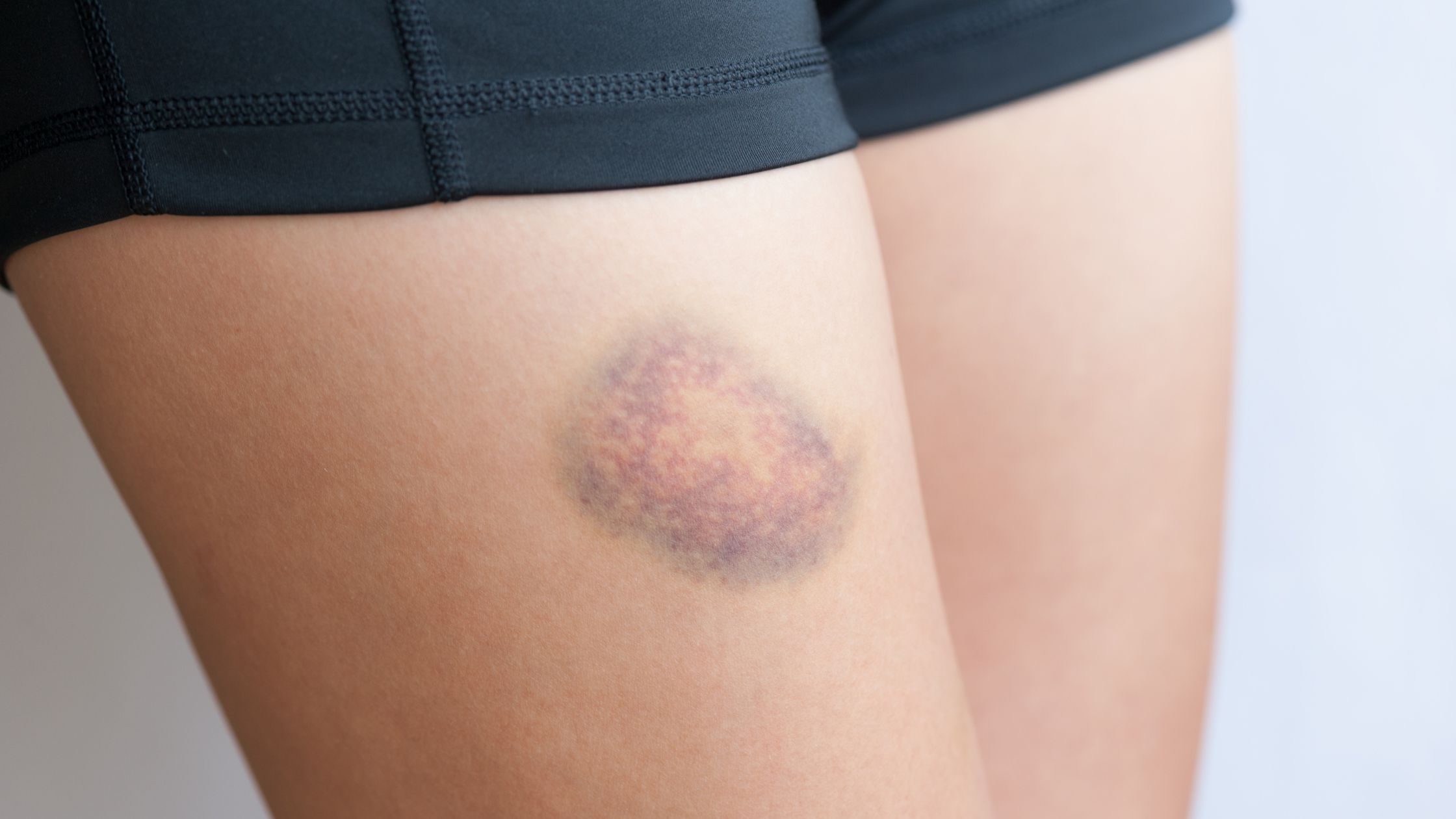 dermatologista para hematomas
