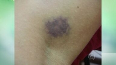 compressa morna para hematoma