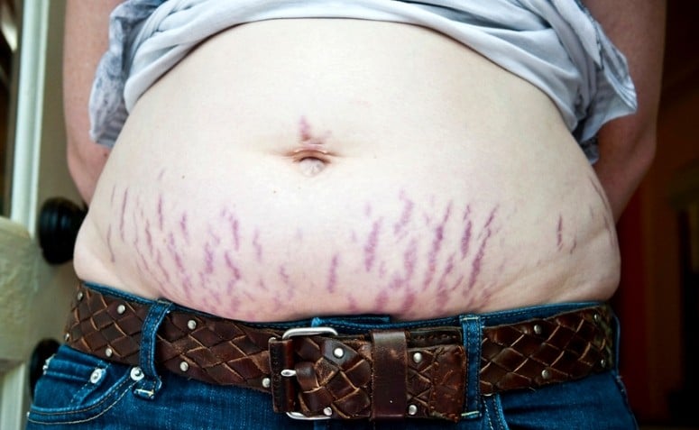 como tratar estrias vermelhas