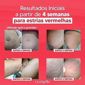 melhores tratamentos para estrias vermelhas em casa