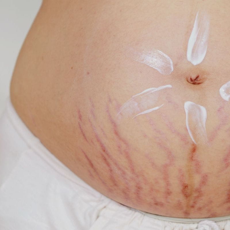 erros comuns ao tratar estrias vermelhas