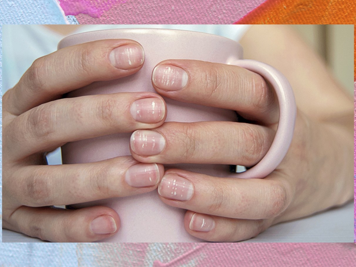 diferença entre mancha branca por batida e fungo na unha