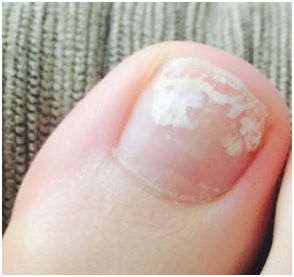 quanto tempo leva para mancha branca de batida sumir da unha