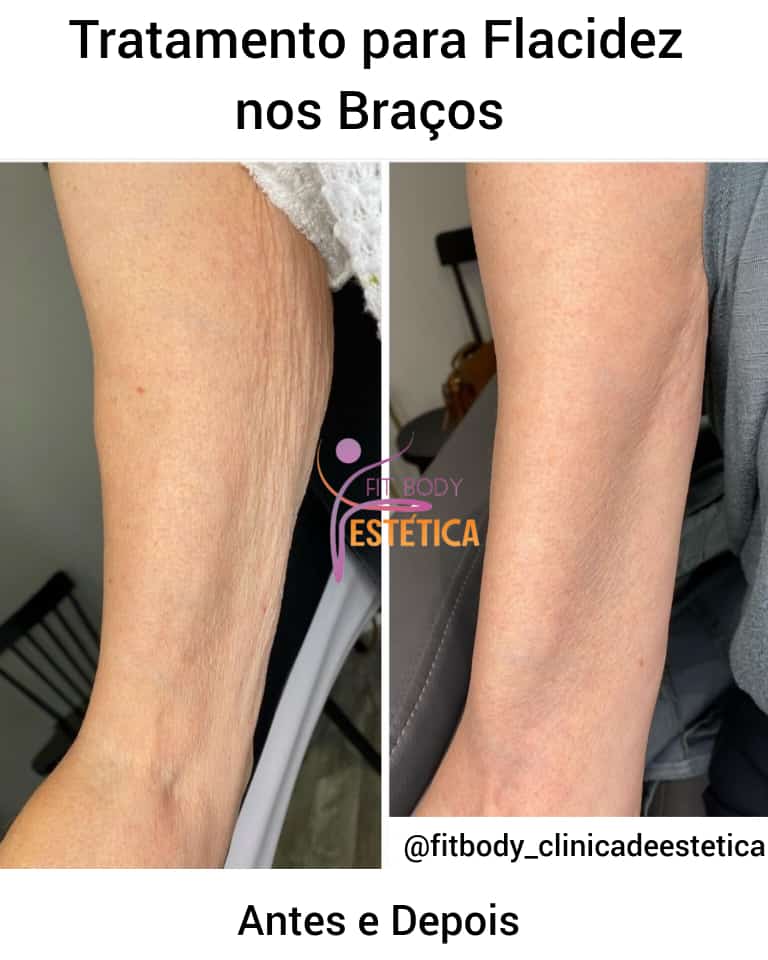 Procedimentos Dermatológicos para Flacidez: Bioestimuladores de Colágeno
