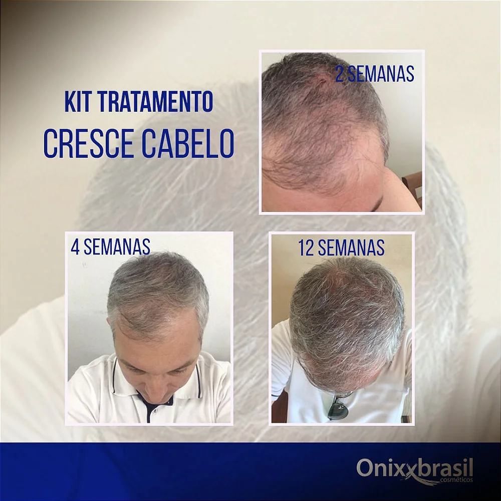 As Melhores Vitaminas e Suplementos para Acelerar o Crescimento do Cabelo