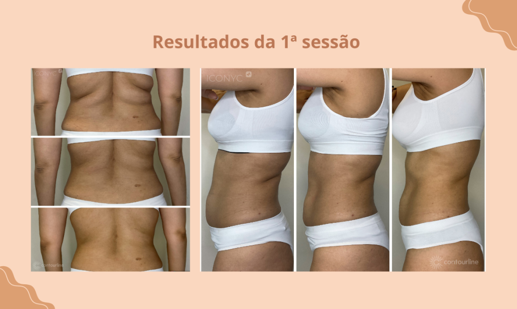 diferença entre criofrequência e criolipólise