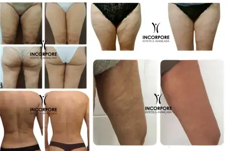 criofrequência para flacidez