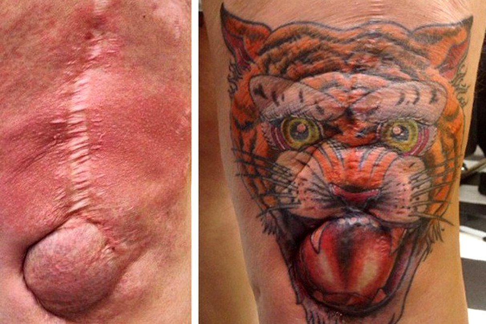 custo de tratamento de queloide por má alimentação tatuagem