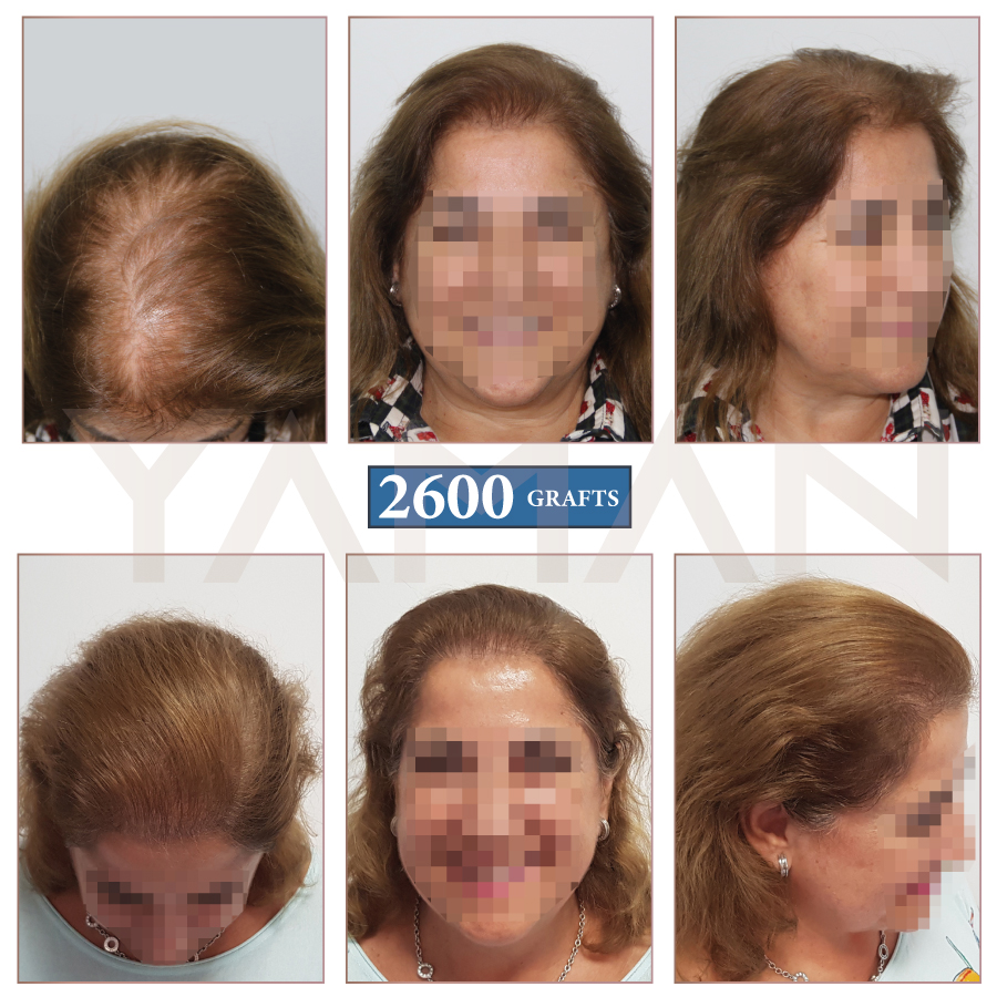 Custo transplante capilar feminino Boa Vista