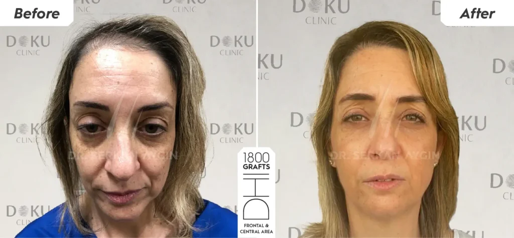 5 ideias de títulos:
1. Transplante Capilar Feminino em Boa Vista: Guia Completo de Custos e Clínicas.
2. Fatores que Influenciam o Preço do Transplante Capilar Feminino em Roraima.
3. As Melhores Clínicas para Transplante Capilar Feminino em Boa Vista (RR).
4. Microagulhamento e Ozonioterapia: Alternativas ao Transplante Capilar Feminino em Boa Vista.
5. Entenda o Custo do Transplante Capilar Feminino: O que Você Precisa Saber.