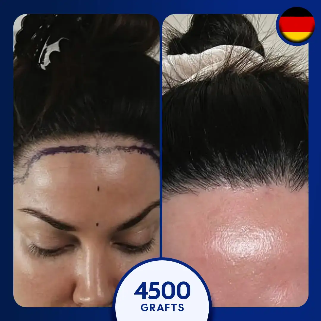 Custo transplante capilar feminino Boa Vista