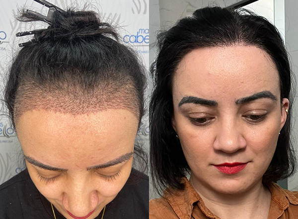 5 ideias de títulos:
1. Transplante Capilar Feminino em Boa Vista: Guia Completo de Custos e Clínicas.
2. Fatores que Influenciam o Preço do Transplante Capilar Feminino em Roraima.
3. As Melhores Clínicas para Transplante Capilar Feminino em Boa Vista (RR).
4. Microagulhamento e Ozonioterapia: Alternativas ao Transplante Capilar Feminino em Boa Vista.
5. Entenda o Custo do Transplante Capilar Feminino: O que Você Precisa Saber.