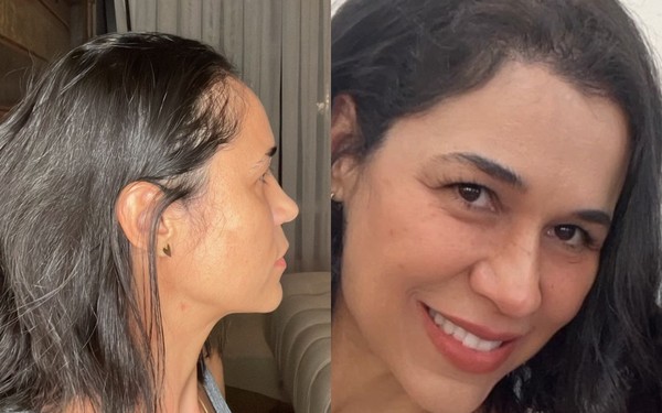 Custo transplante capilar feminino Boa Vista