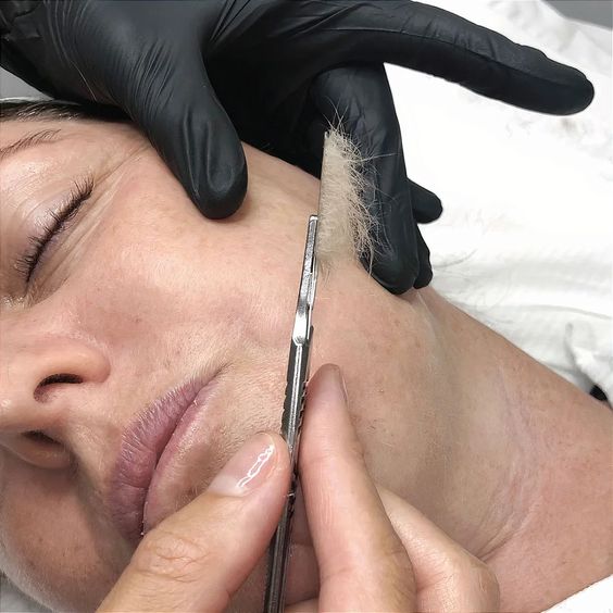 dermaplaning erros comuns pioram poros