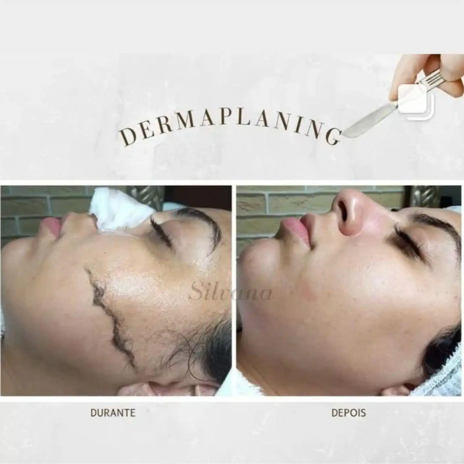 dermaplaning riscos e como evitar irritação na pele