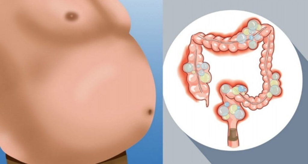 Distensão Abdominal