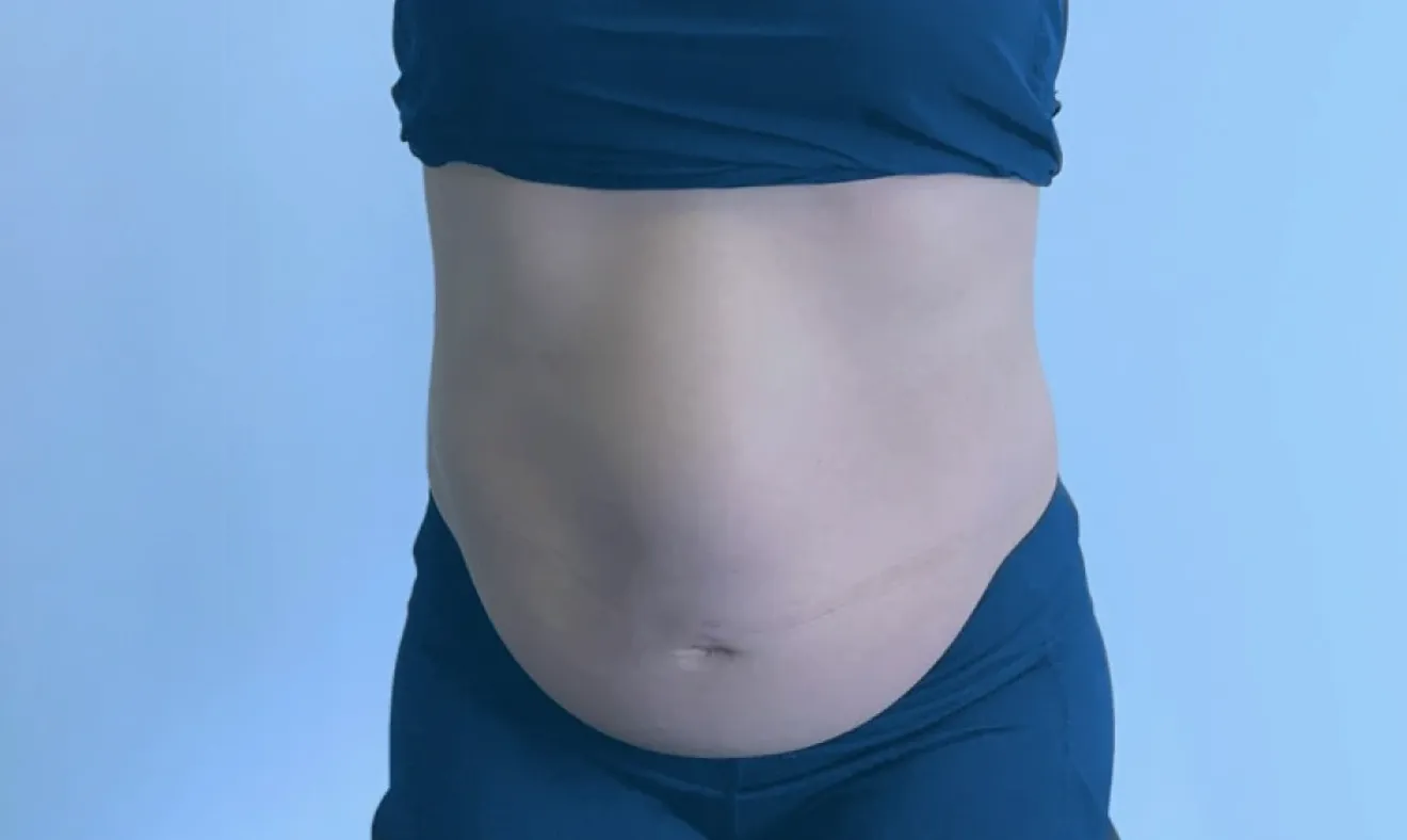 Alimentos que causam inchaço abdominal: Guia completo para evitar a distensão