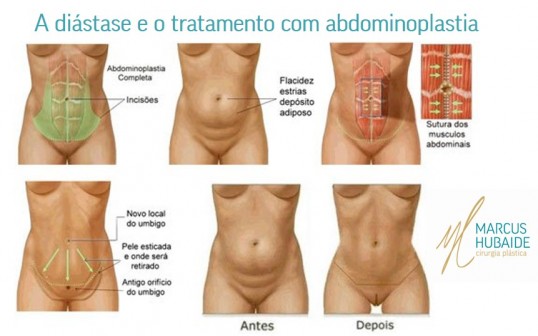 Remédios caseiros e chás para aliviar a barriga inchada rapidamente