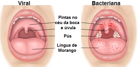 Quando a Dor de Garganta é Sinal de Algo Mais Grave?