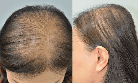 Alopecia: Tipos