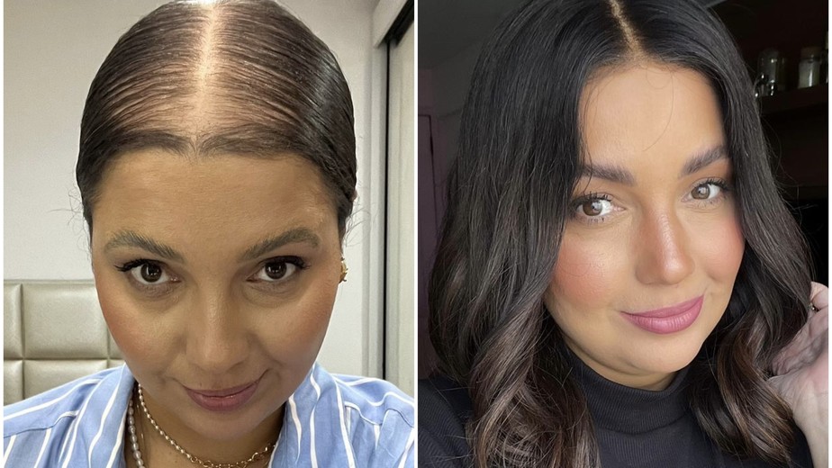 Transplante Capilar FUE em Vitória: O que você precisa saber