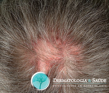 MMP para Foliculite Decalvante: Como Funciona e Resultados Esperados