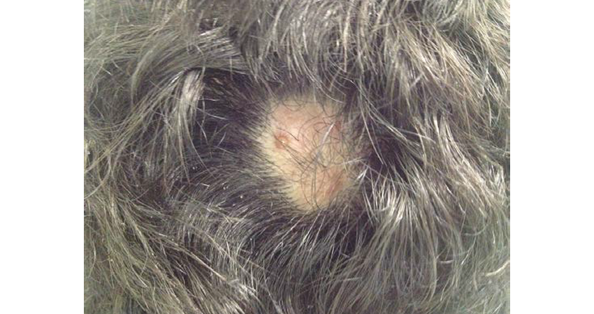 Terapias Complementares para Foliculite Decalvante: Laser e Ozônio