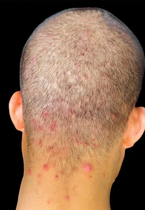 Diferença entre Foliculite Decalvante e Foliculite Dissecante: Guia Completo