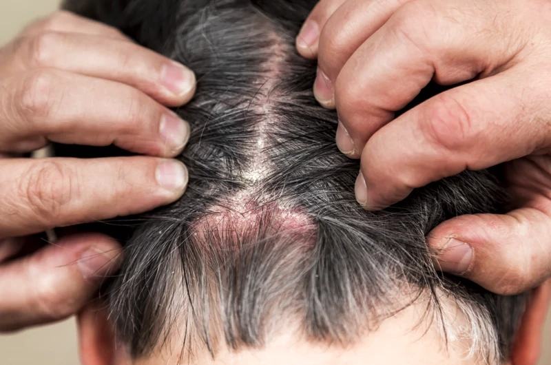 Guia de Tratamentos para Alopecia Cicatricial em São Paulo