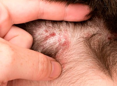 MMP para Foliculite Decalvante: Como Funciona e Resultados Esperados